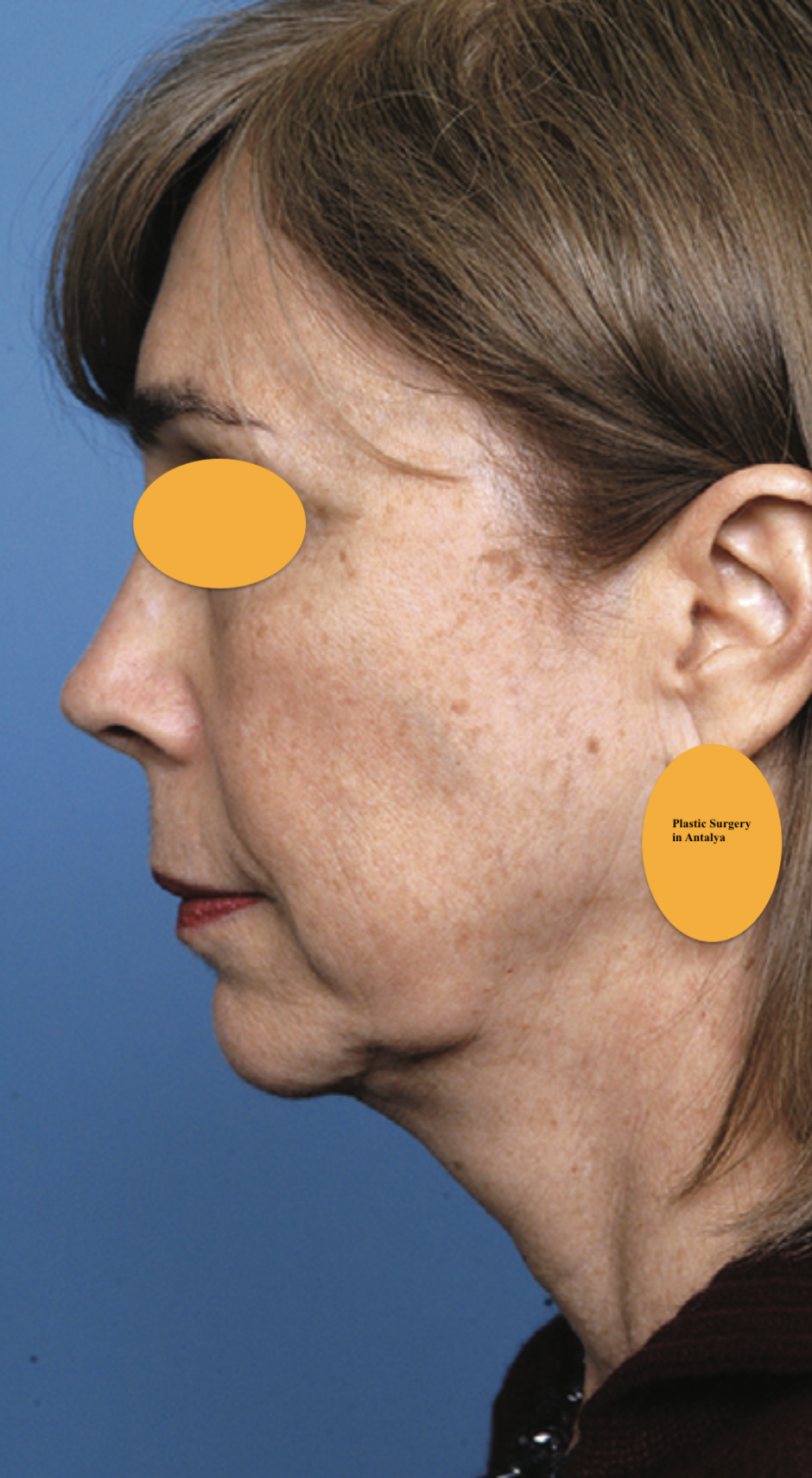 1-smass deep face lift before