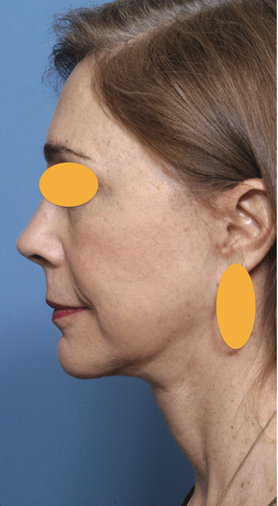 2-after smass deep face lift