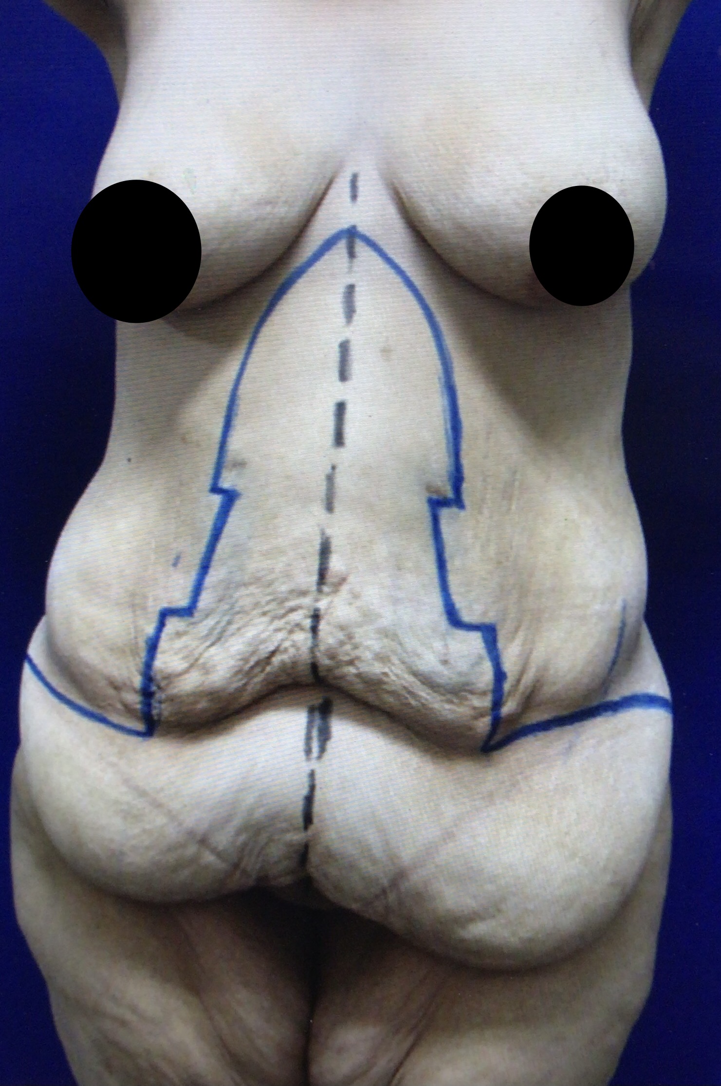 Fleur-de-lis-abdominoplasty