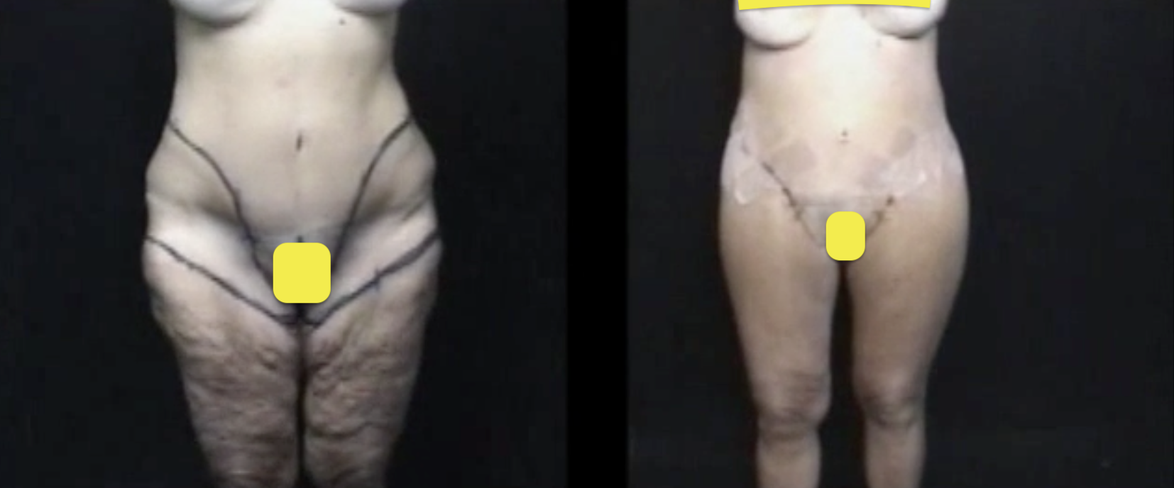 Lower body lift-360-tummytuck