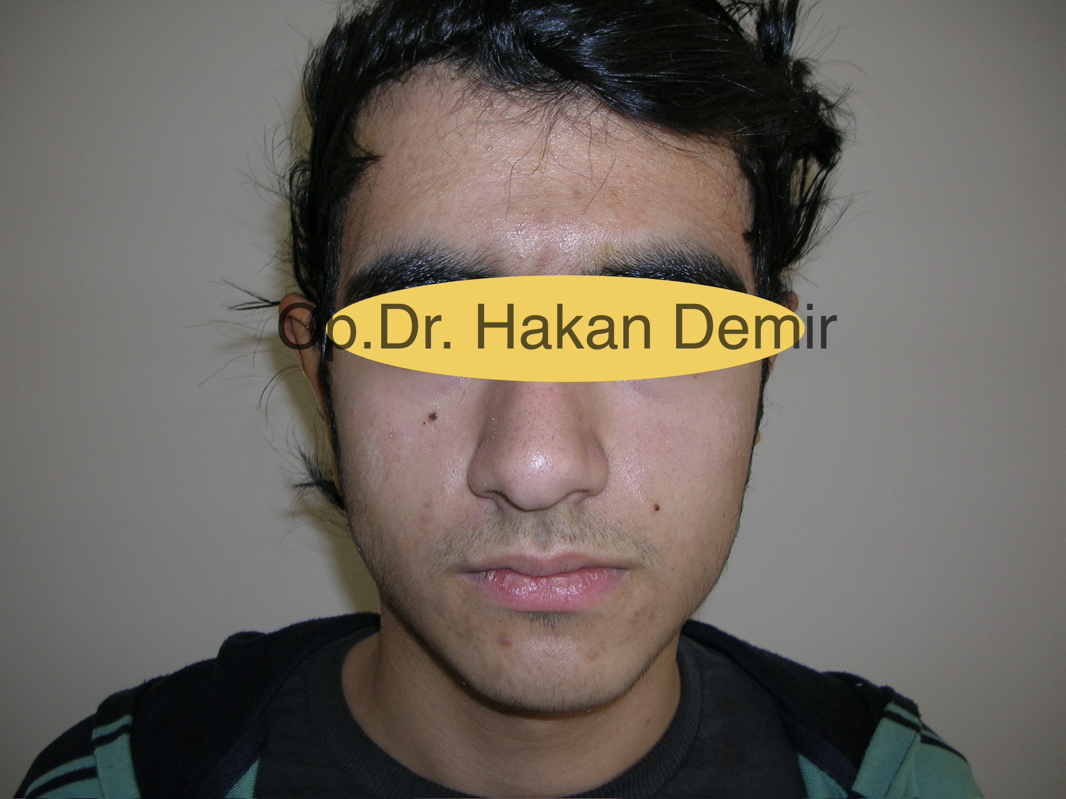 OTOPLASTY-AFTER