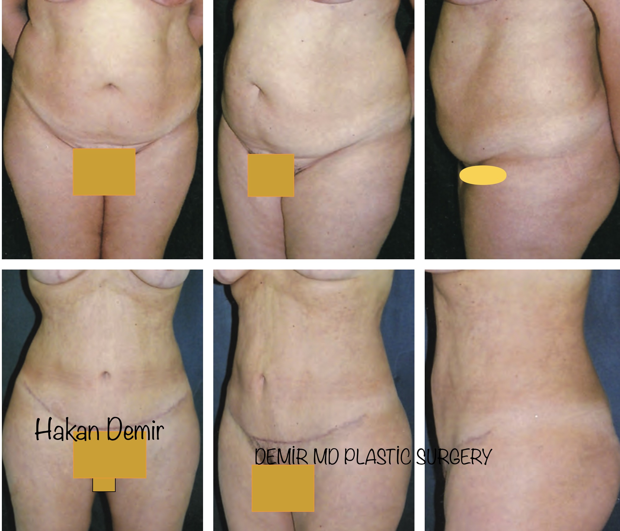 Tummytuck-in-ANTALYA