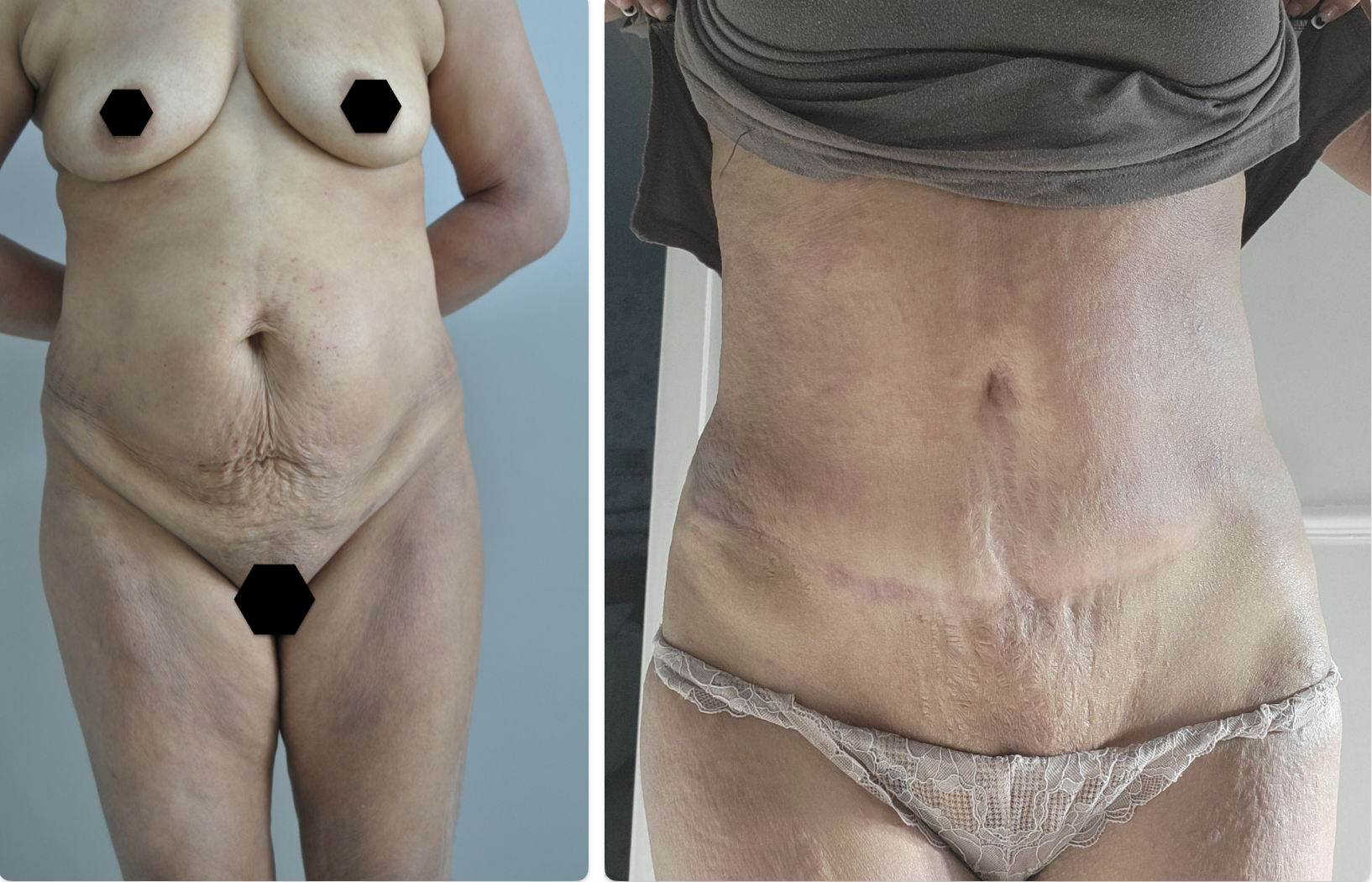 abdominoplasty beforeafter vaser lipo