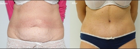 abdominoplasty