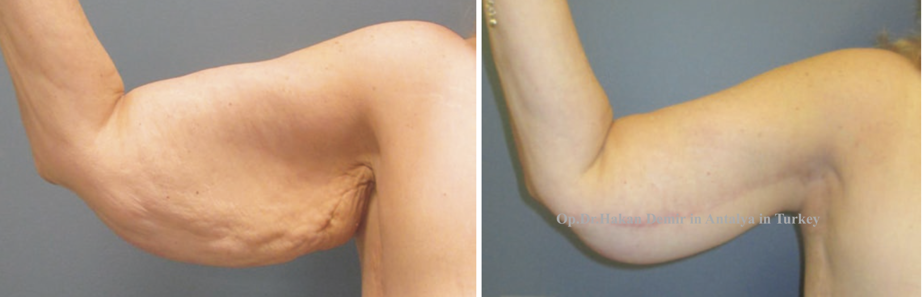 armlift-vaser lipo