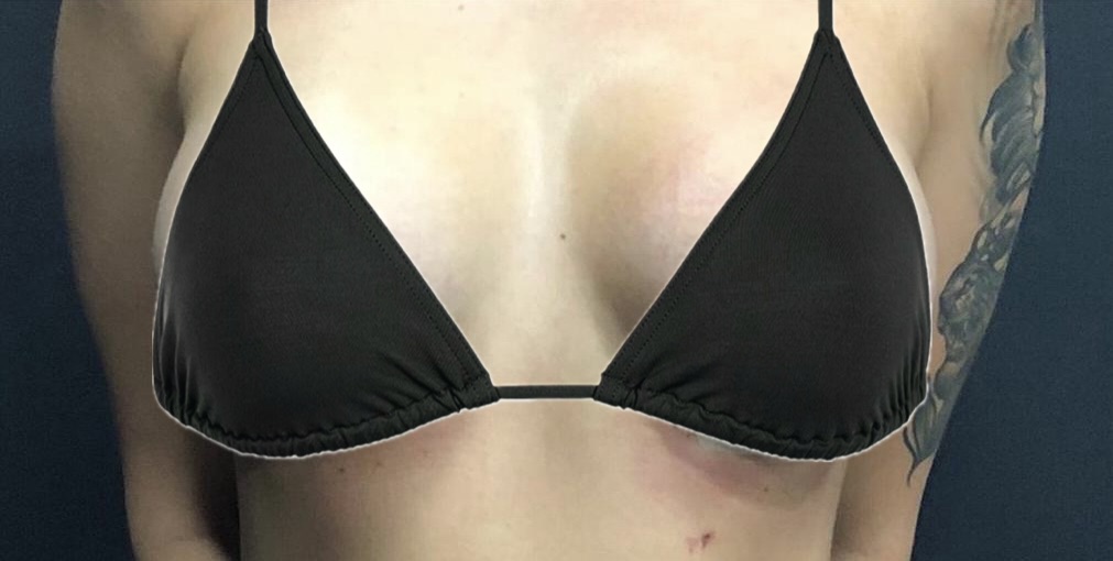 breast augmentation-submusculary