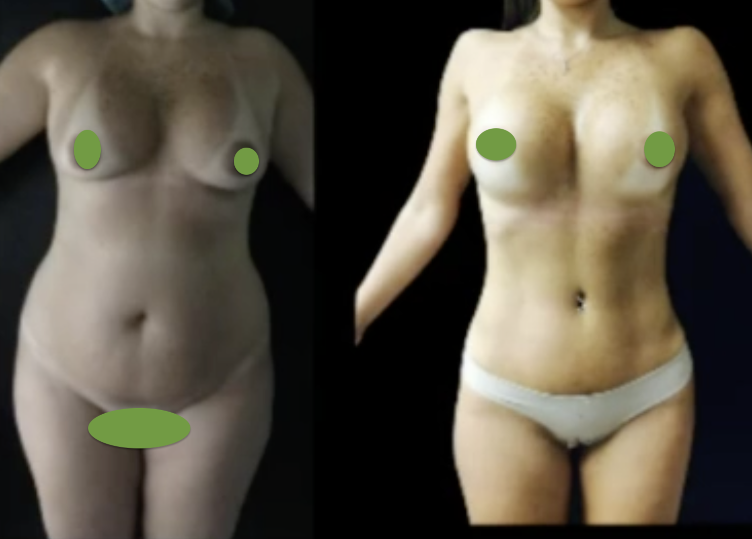 breast augmentaton-tummy tuck-lipo