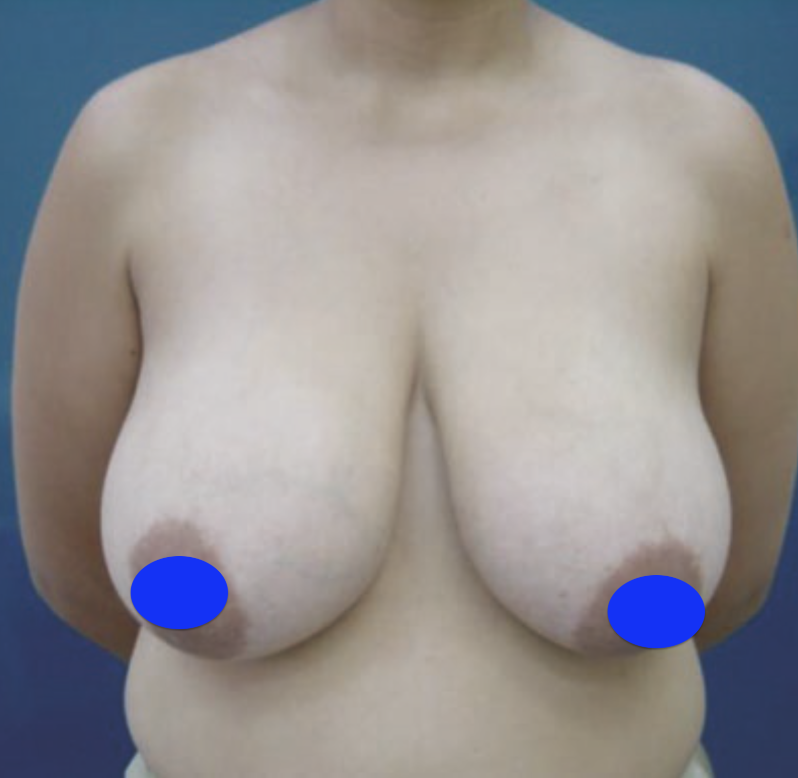 breast reduction before