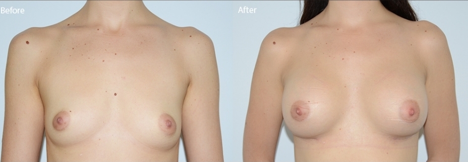 breast-augmentaion