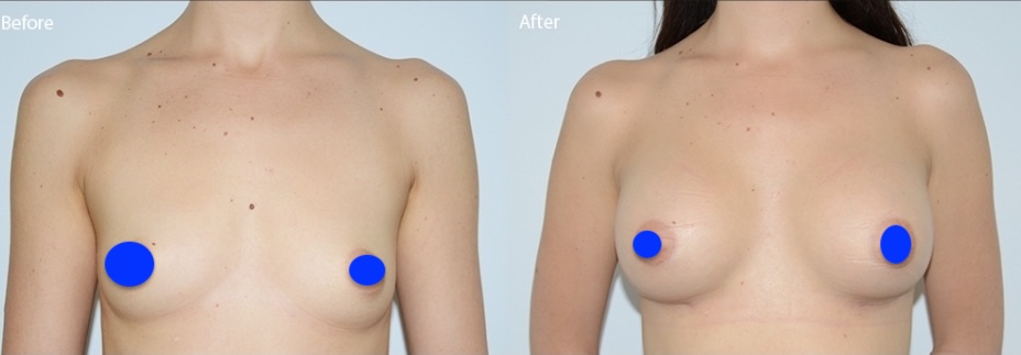 breast-augmentaion2