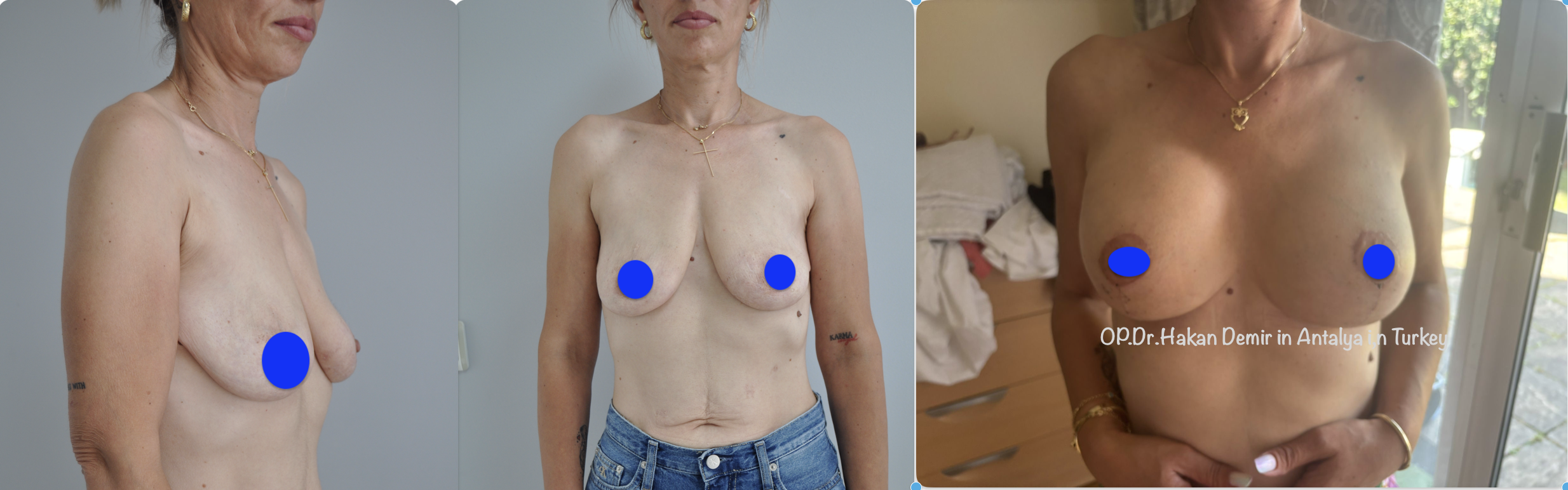 breastlift -augmentation_1