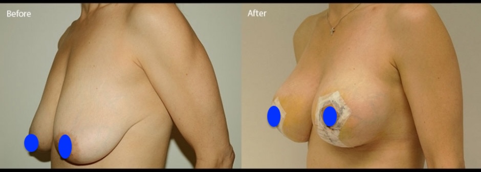 breastlift- augmentatıon (1)_1