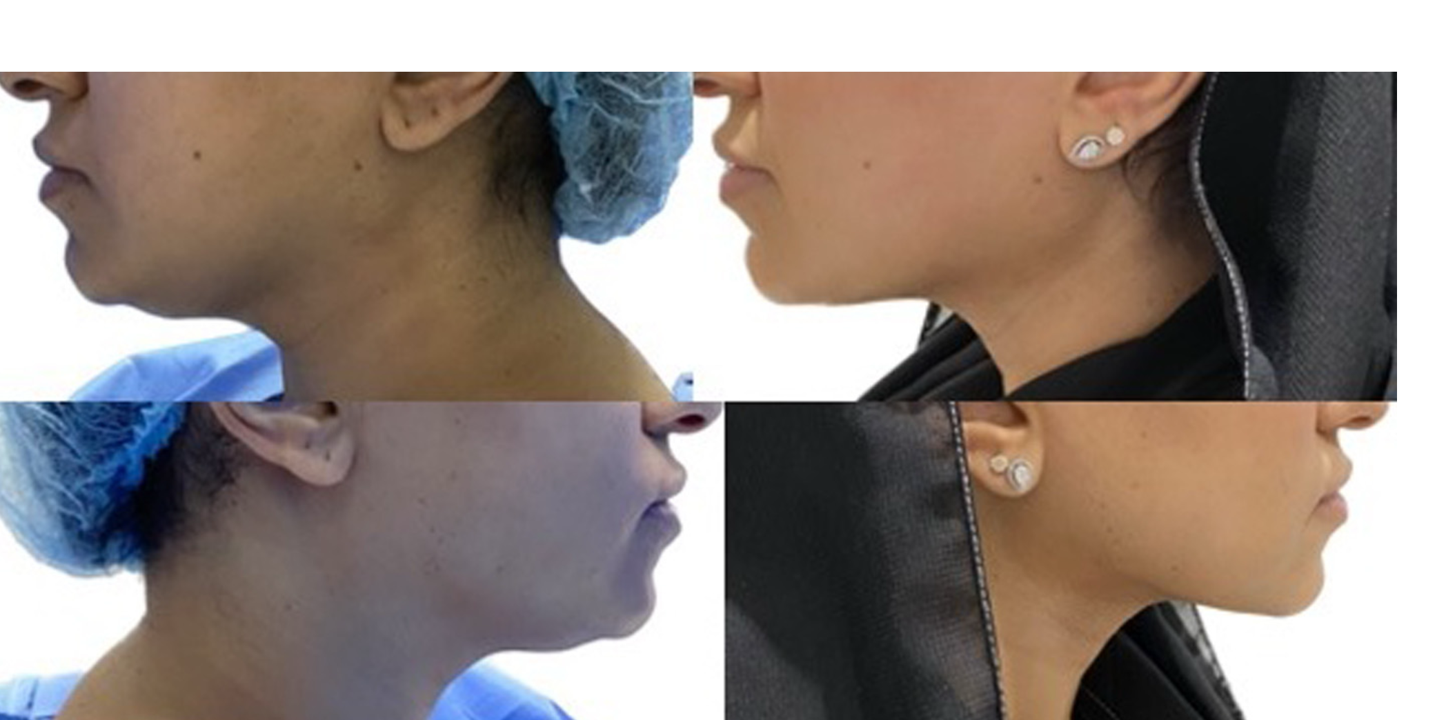 chin lipo