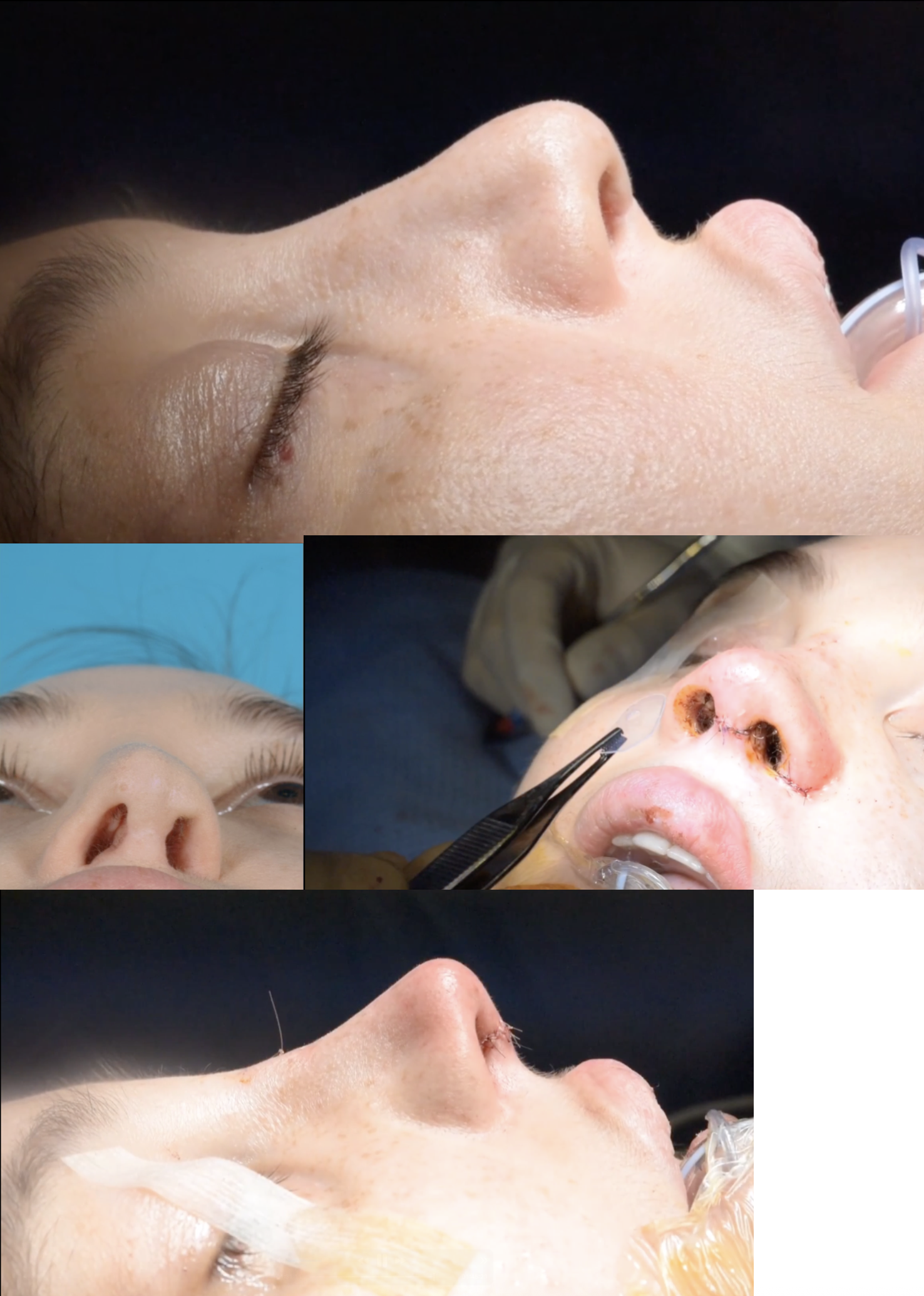 cleft lip nose-yarık-dudak-burnu