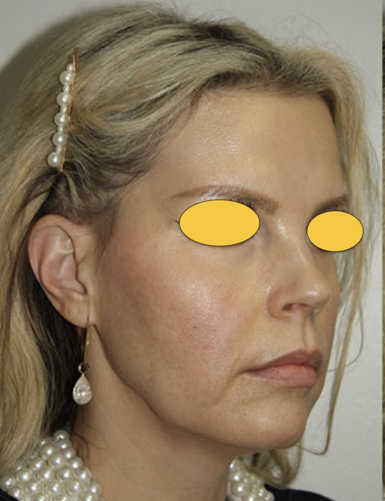 deep plane -face-lift before