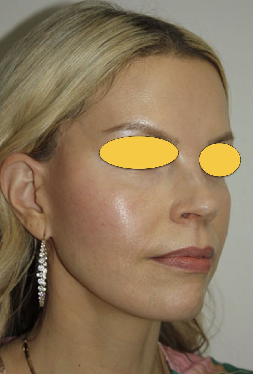 deep plane face-lift after