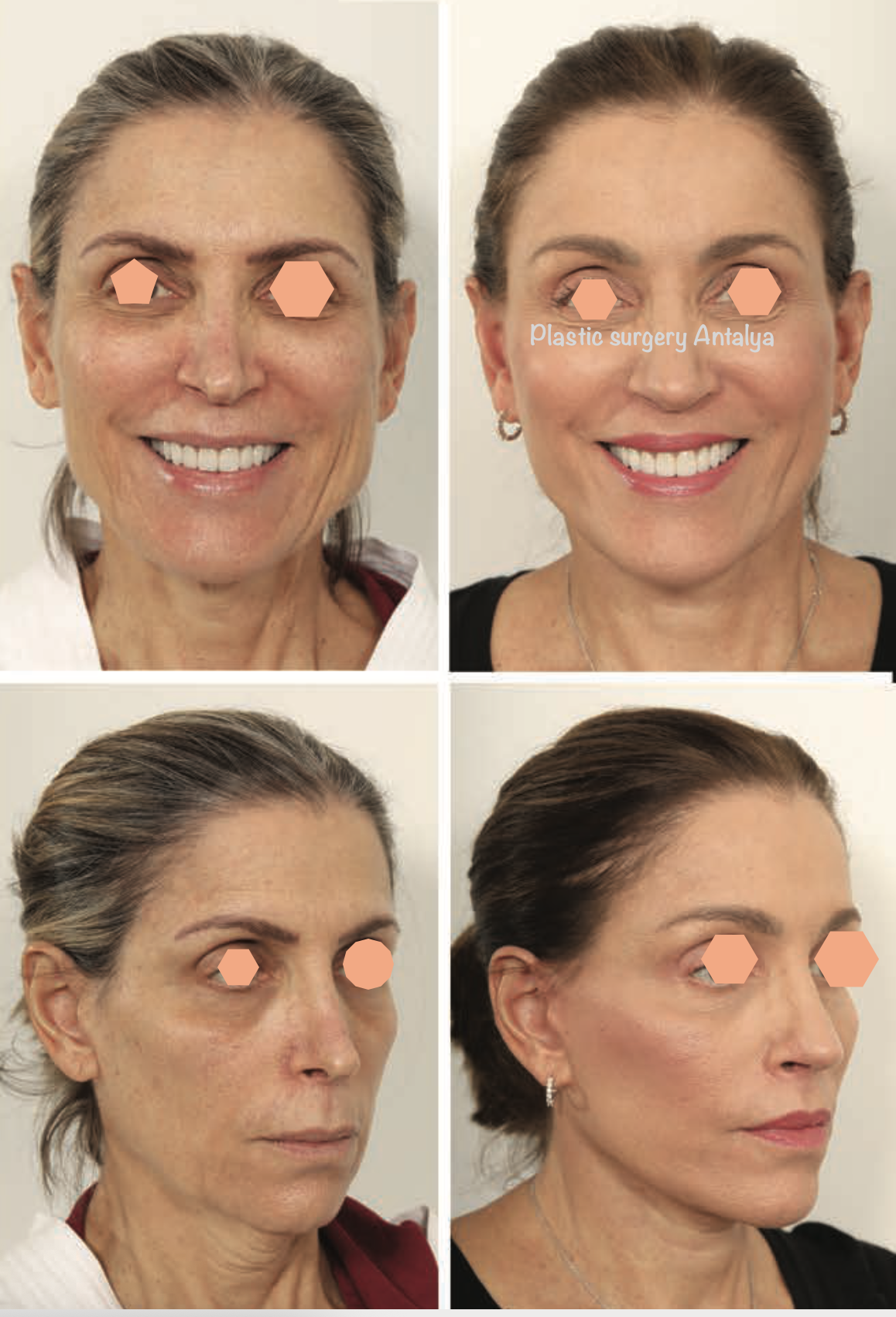 deep-facelift