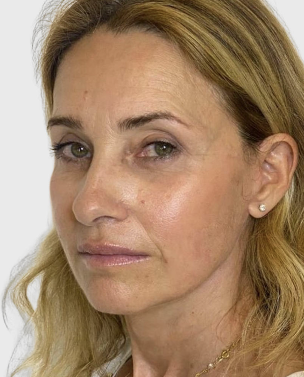 face-neck-lift after