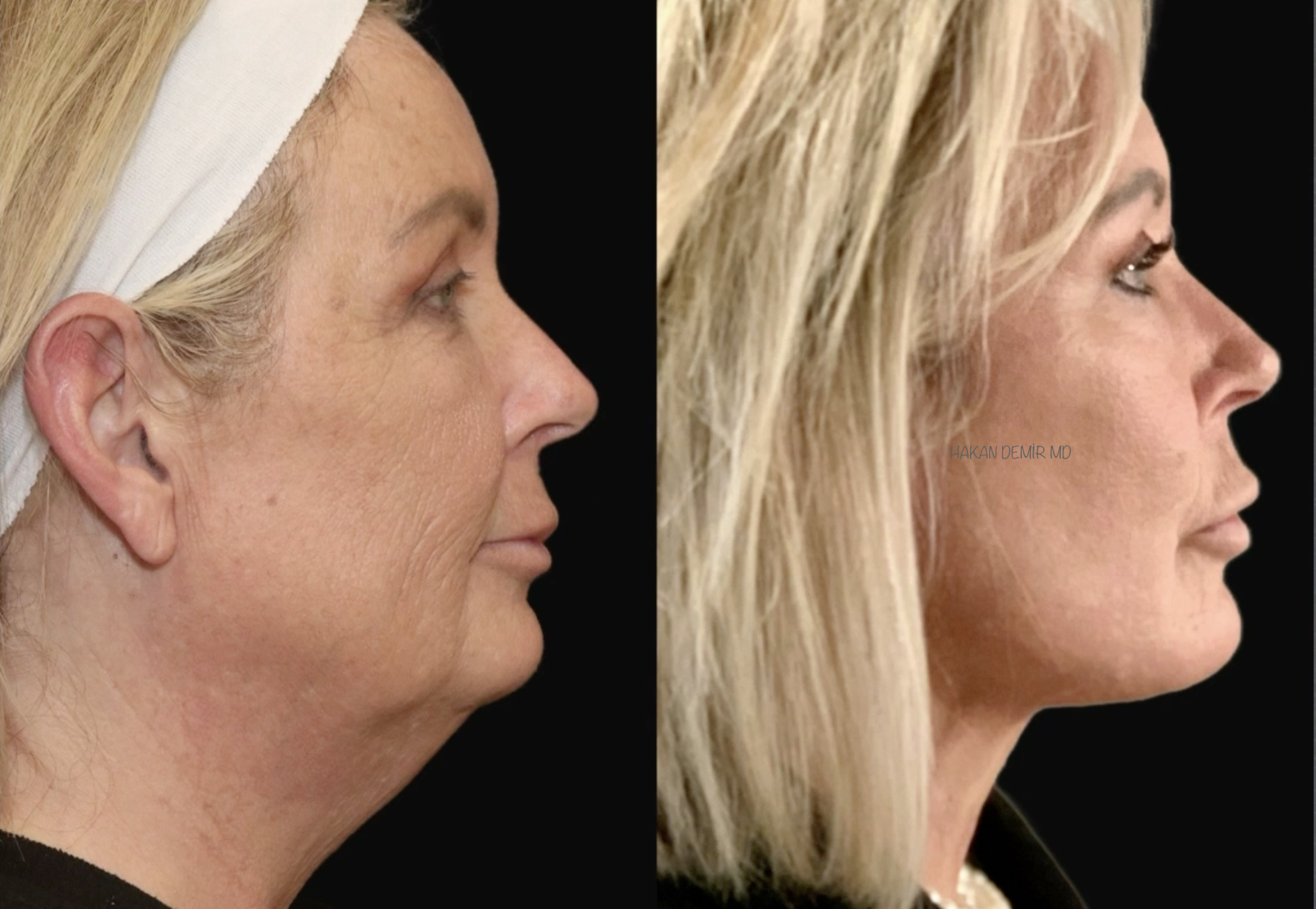 facelifting-neck lift