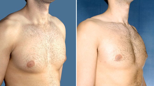 gynecomastia