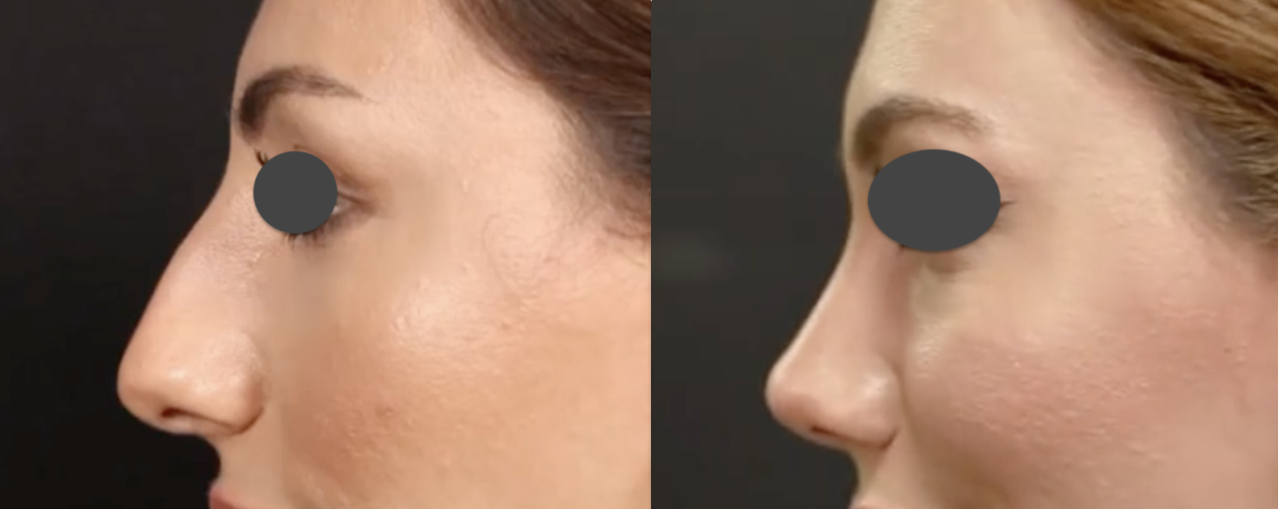 hump-reduction-rhinoplasty