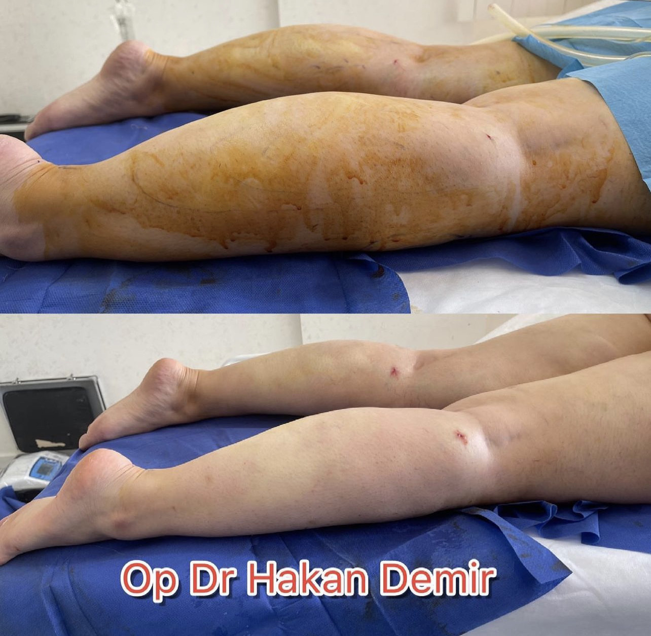 leg-lipo