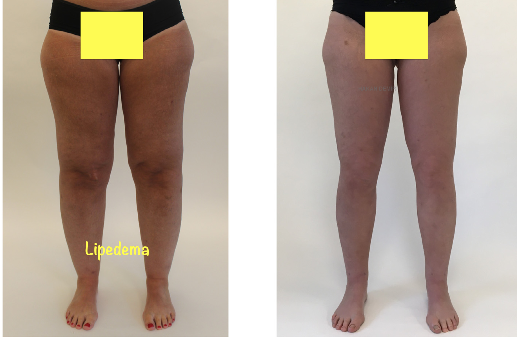 lipedema-before-after