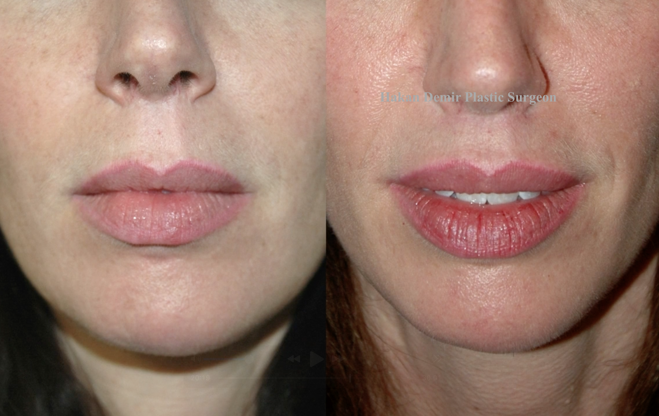 liplift before-after in antalya