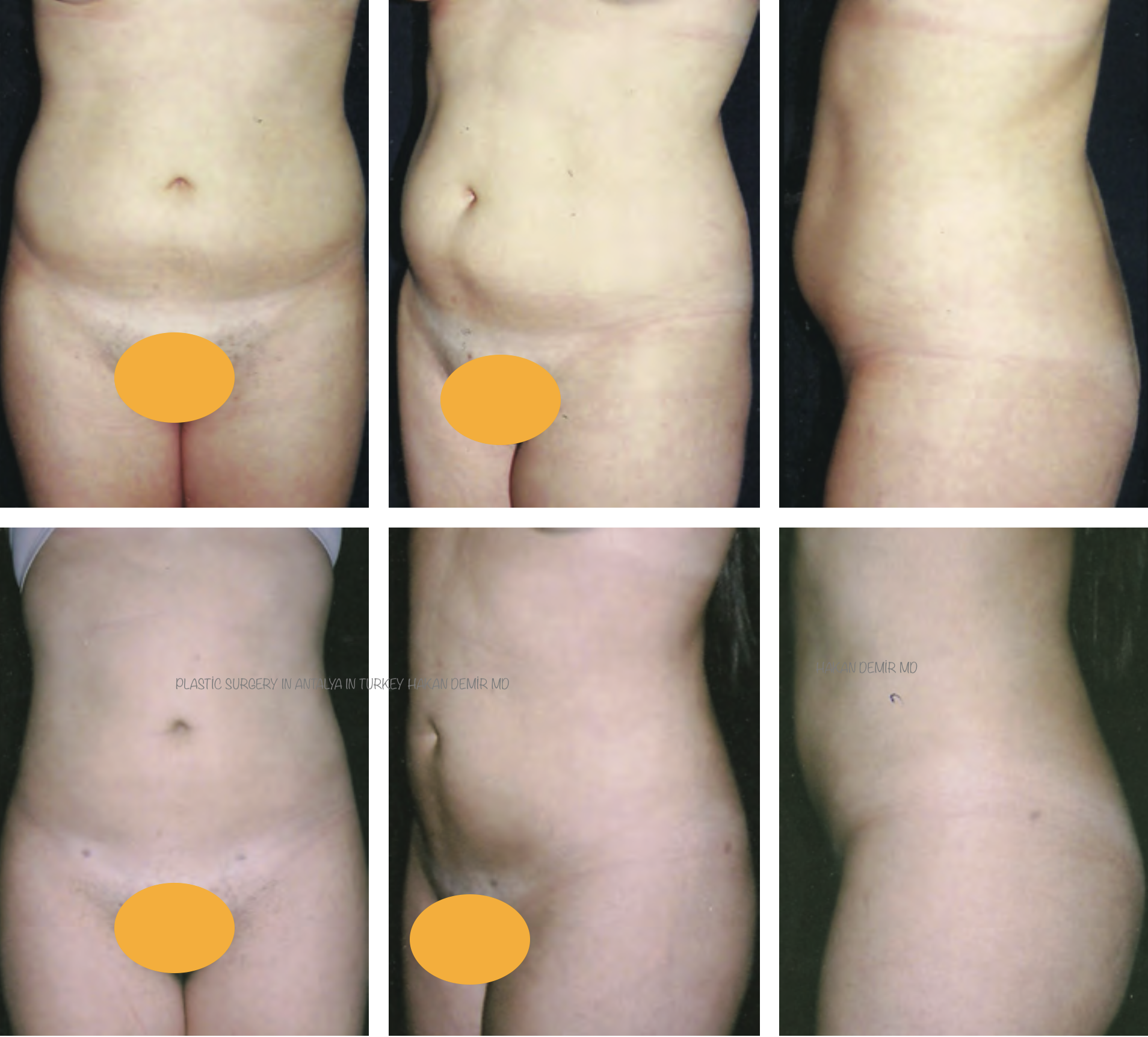 lipo-before-after-inantalya