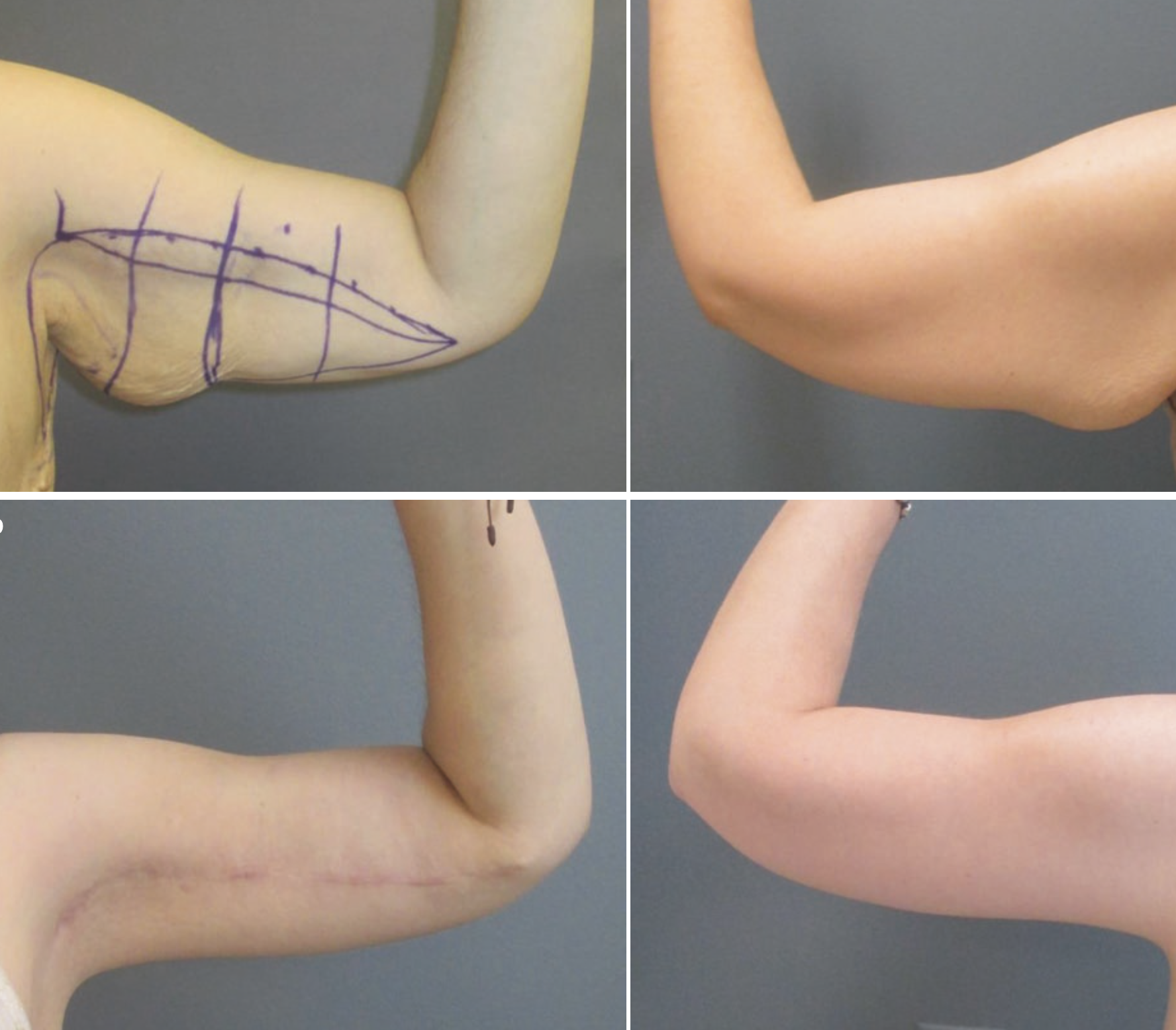 liposuction with arm lift