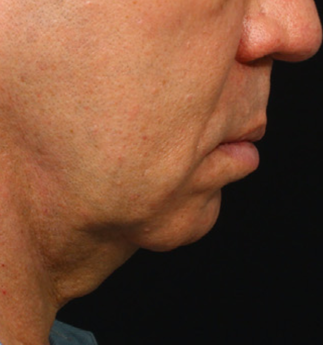 man-face-neck-lift