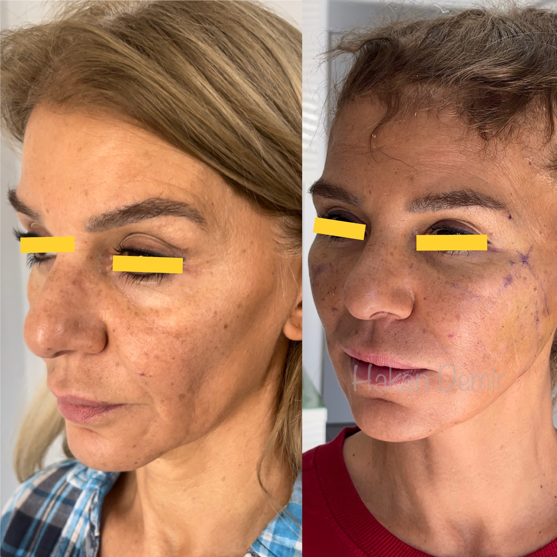 minimal-scar-extented-deep-facelift