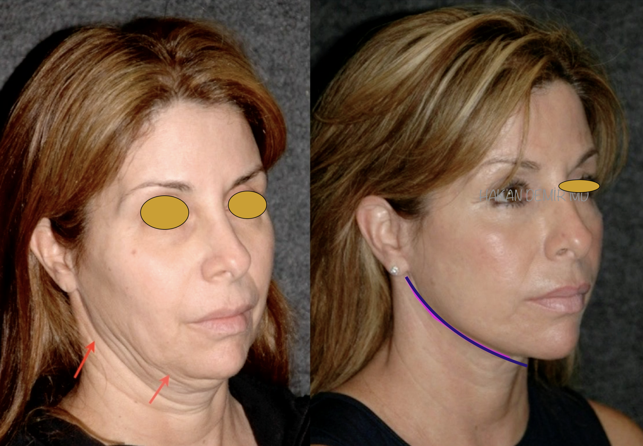 necklift&facelift-surgery