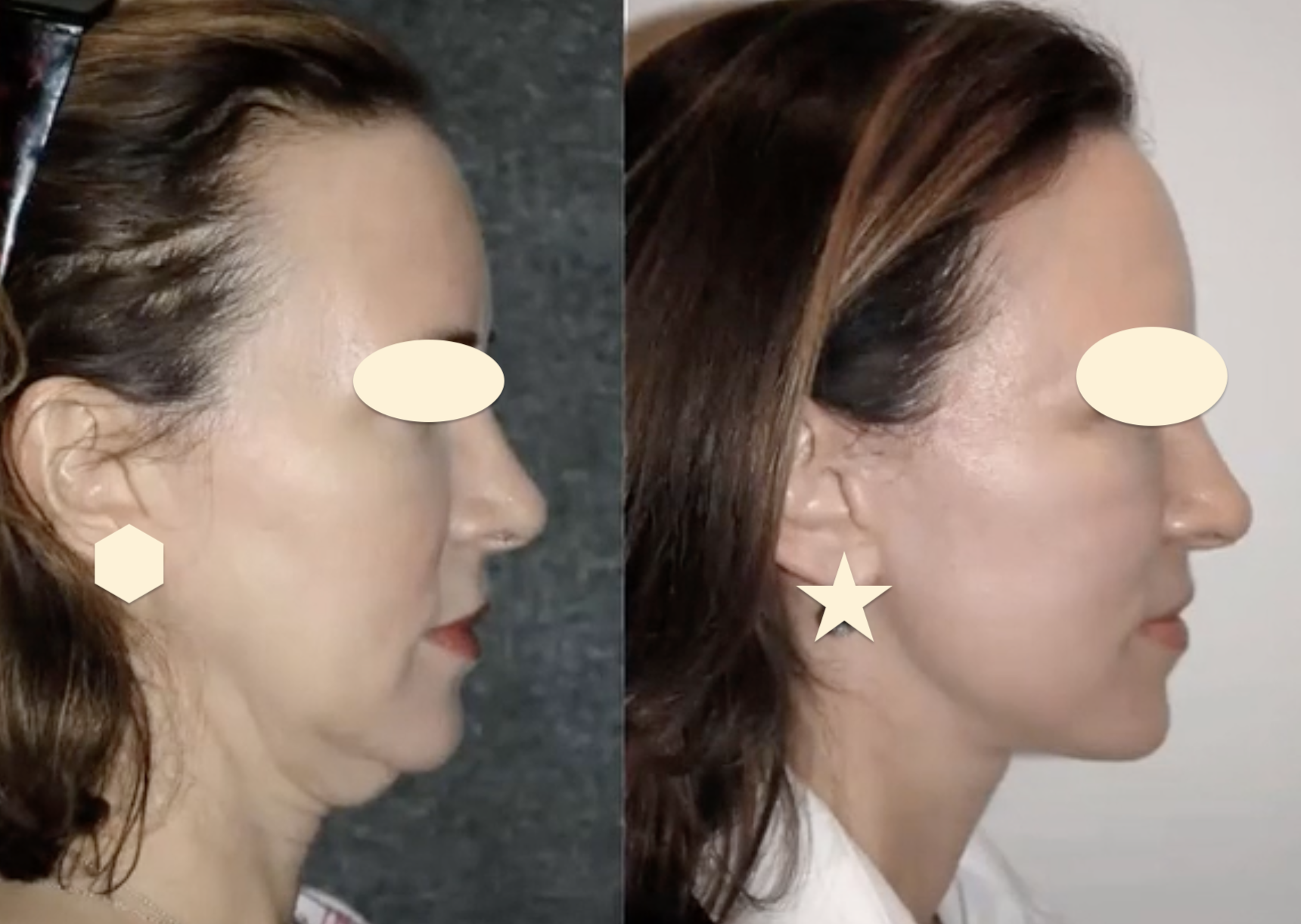 necklift-facelift