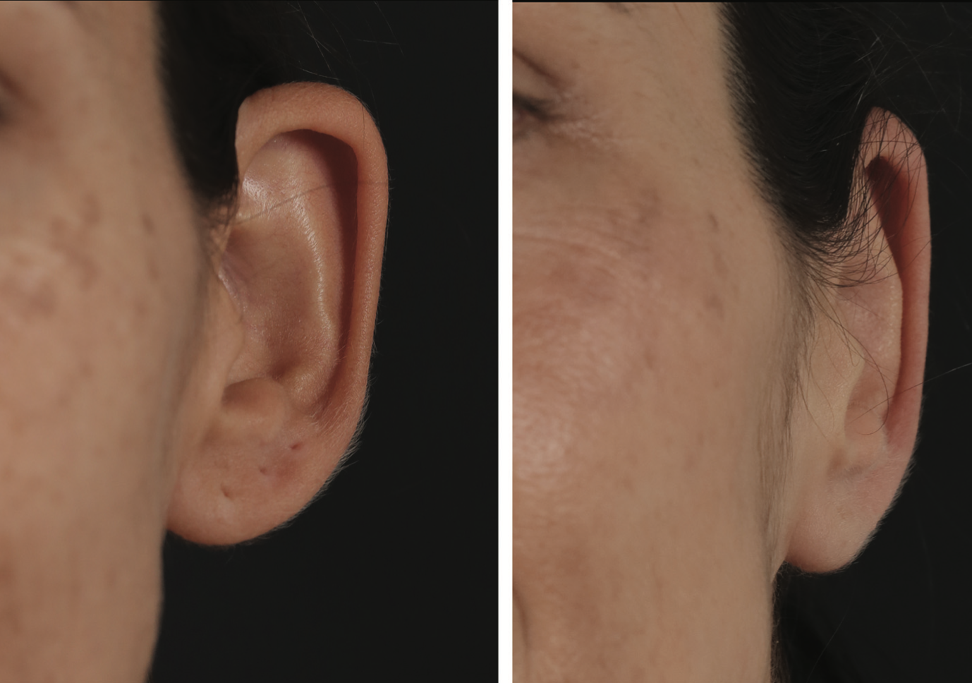 prominent ear-