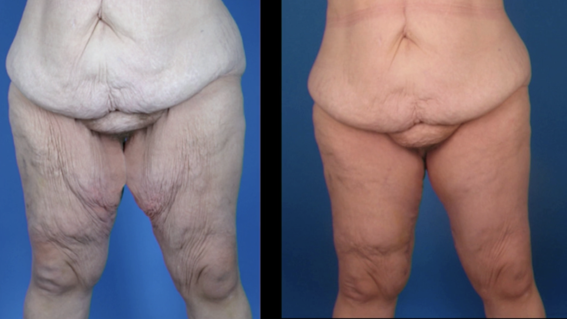 thigh-lift-bacak germe-before-after