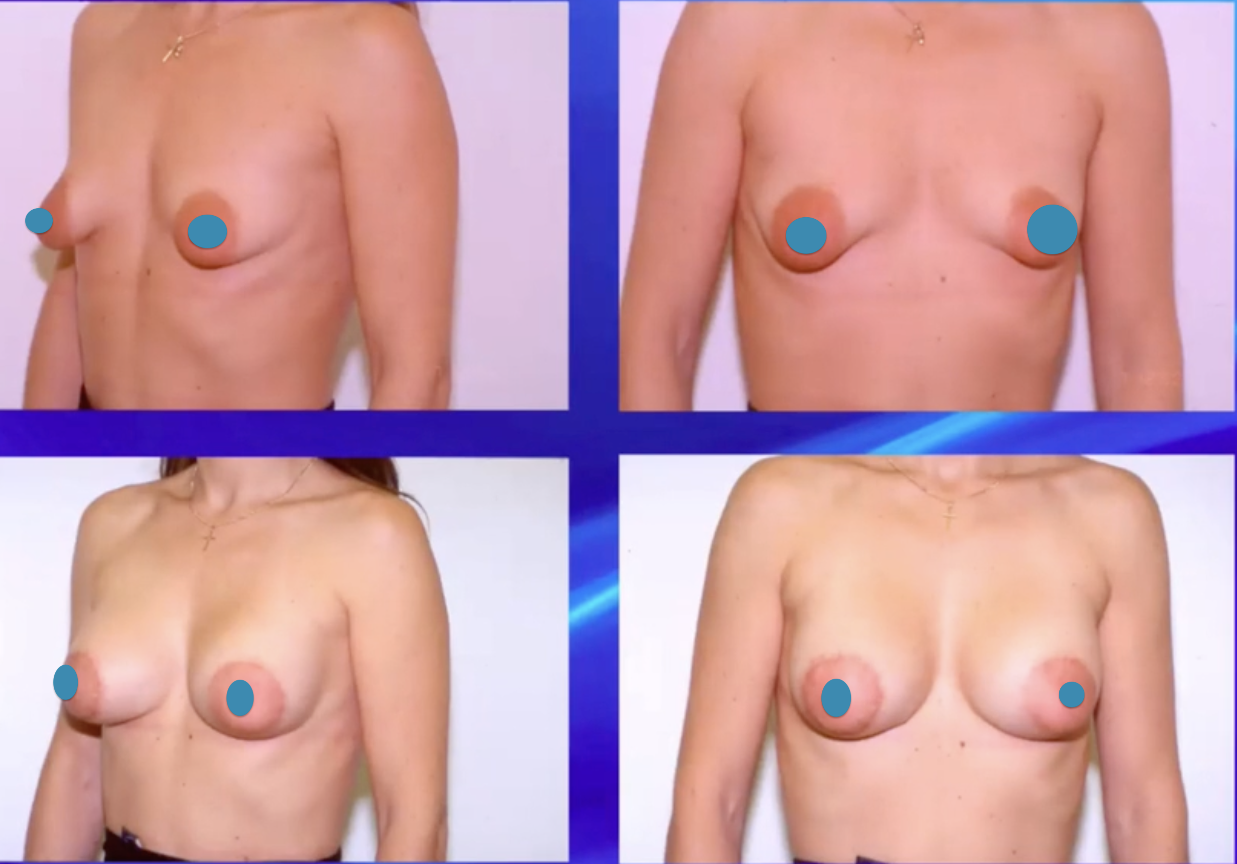 tuberous breast-before-after