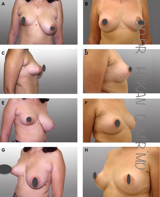 tubulary -breast-keci memesi