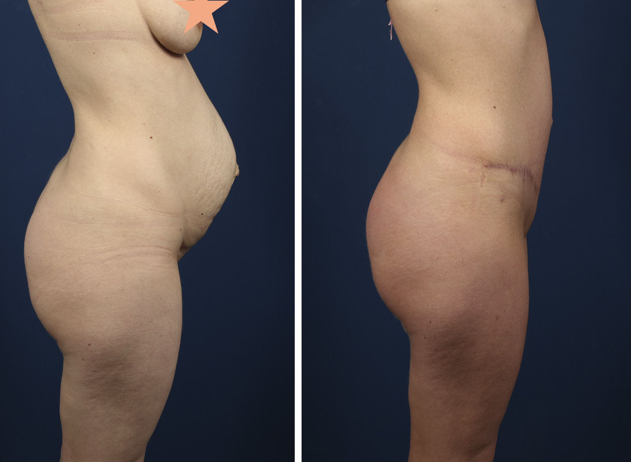 tummy tuck in Antalya 