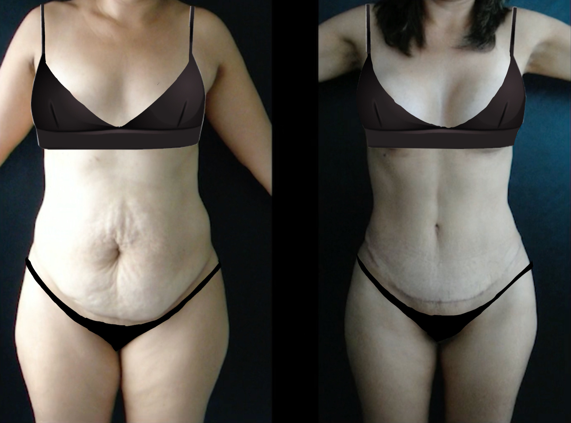 tummy-tuck-in-antalya