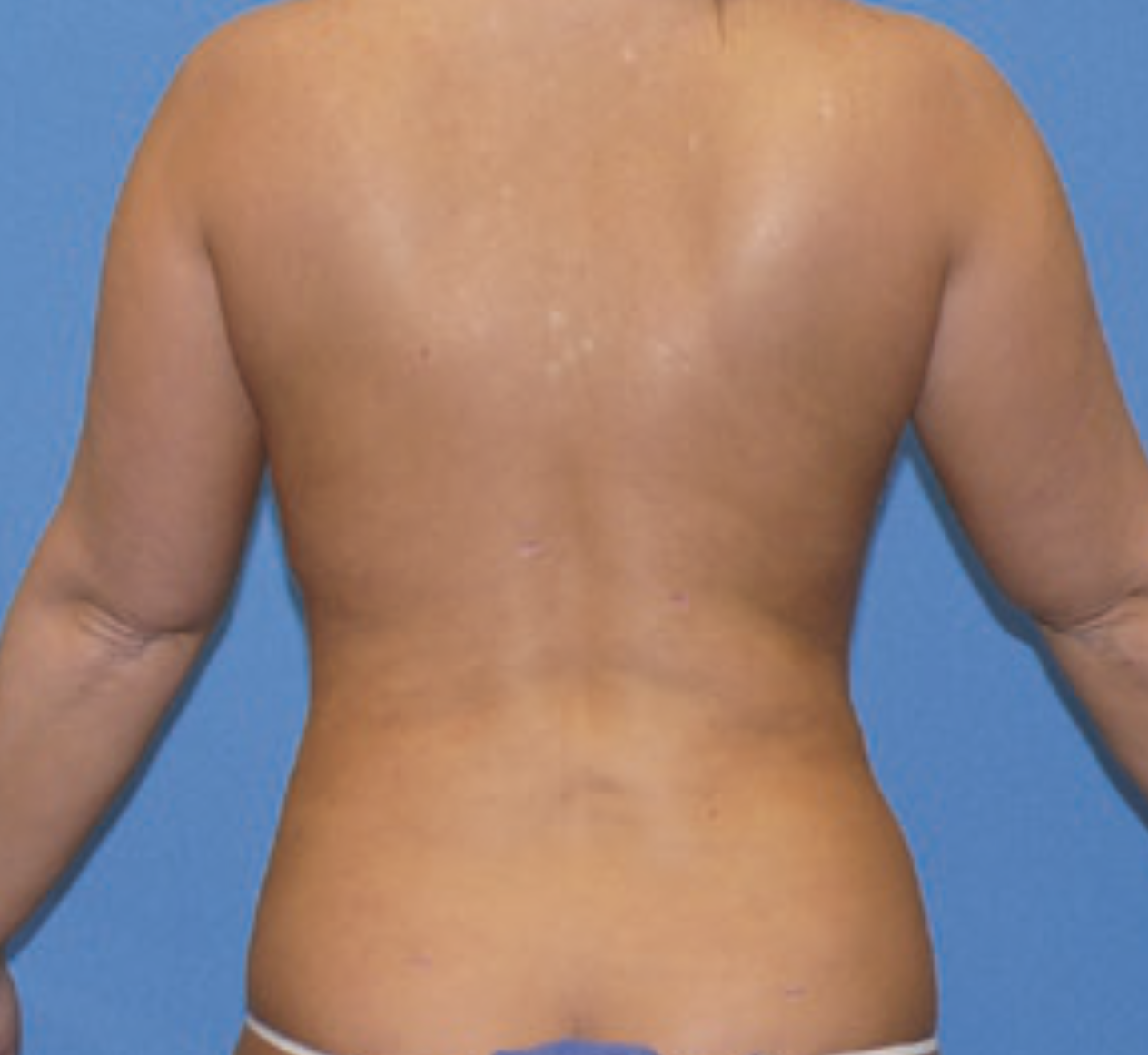 vaser- liposuction after