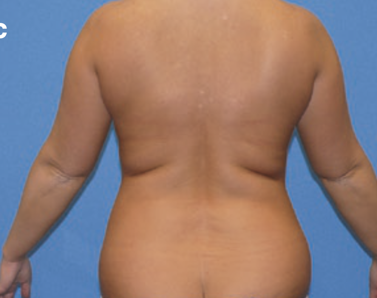 vaser-liposuction bofore